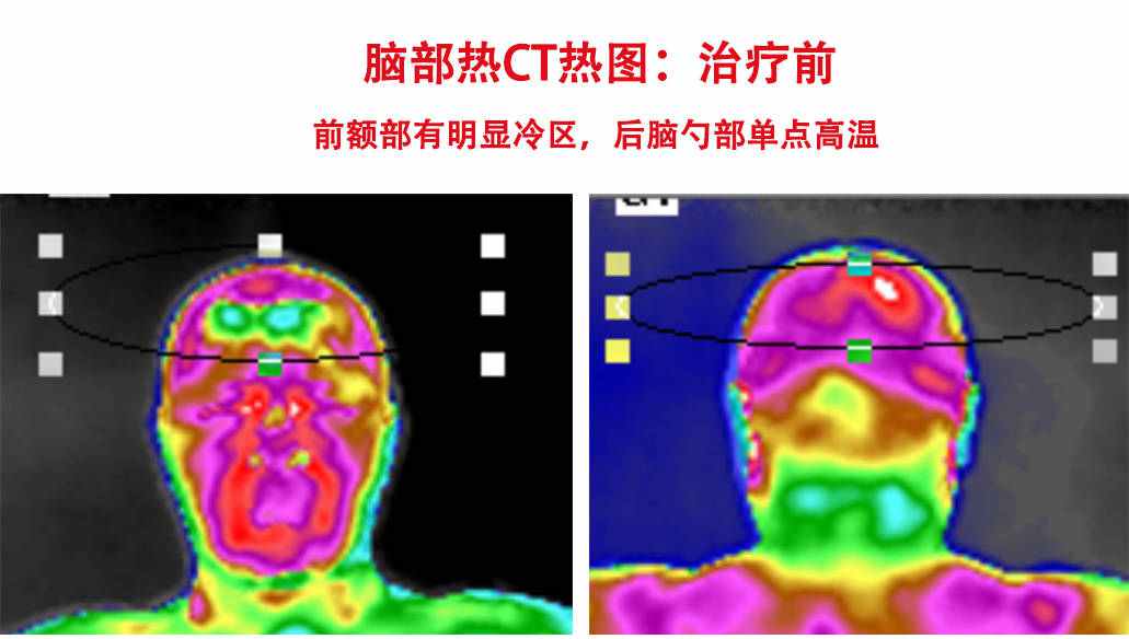 3分钟让你看懂九游会·J9的“脑部热CT”热图解读！